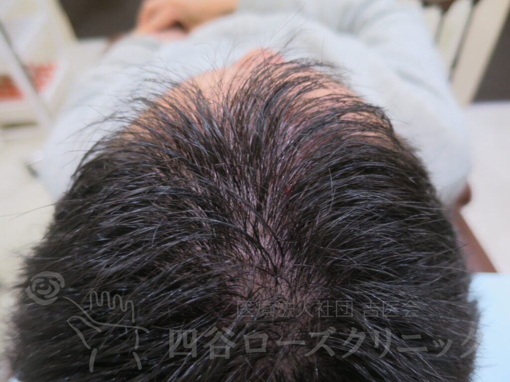 前頭部（進行度Ⅱa） 治療後