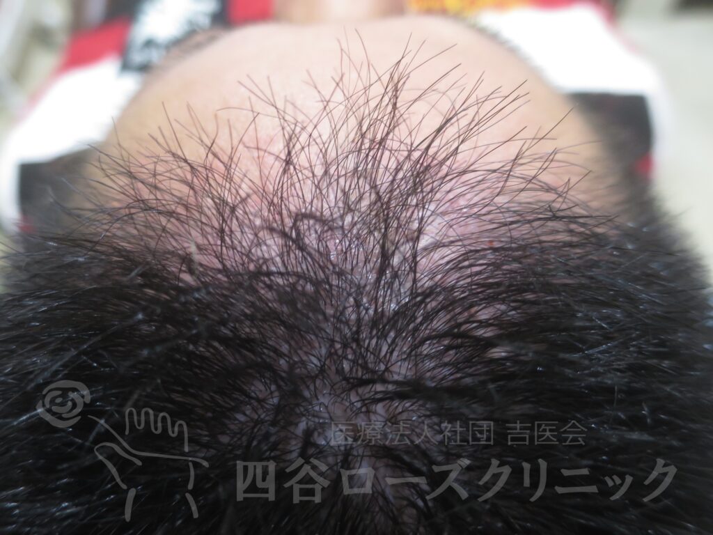 前頭部（進行度Ⅱa） 治療前