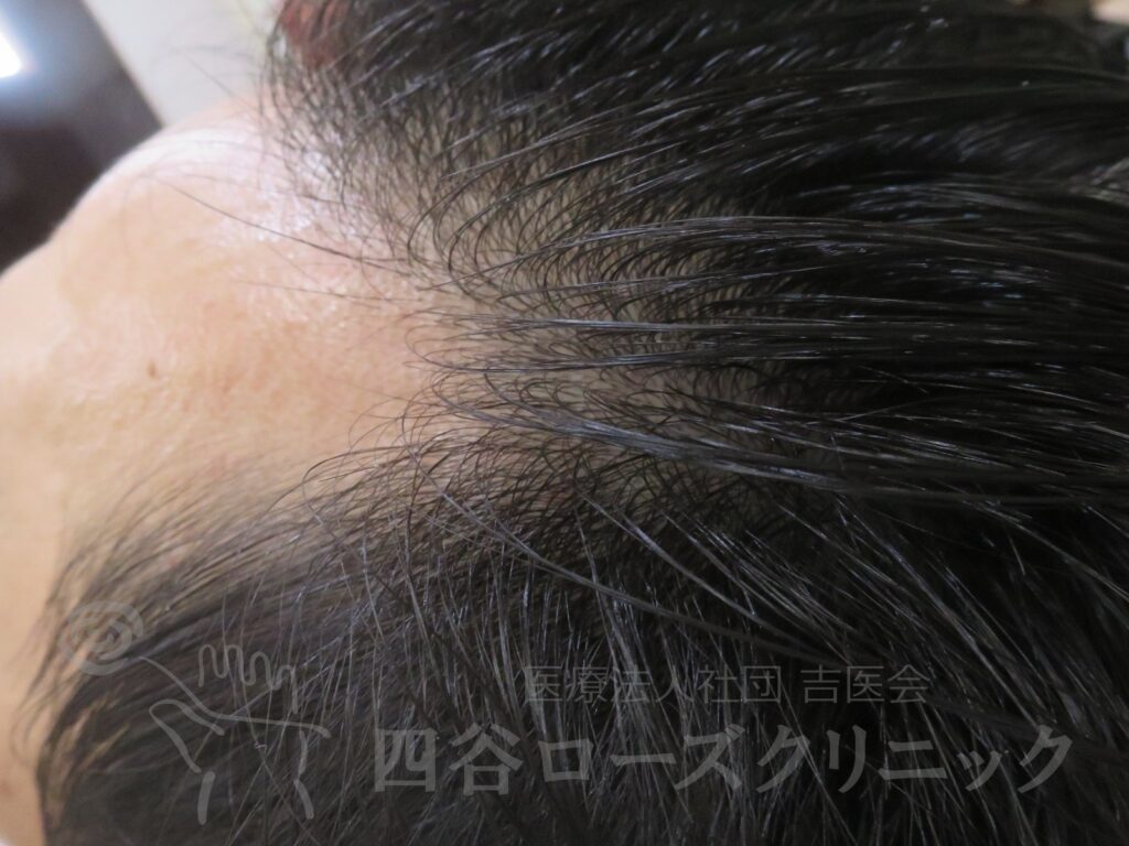 M字の食込み 治療後