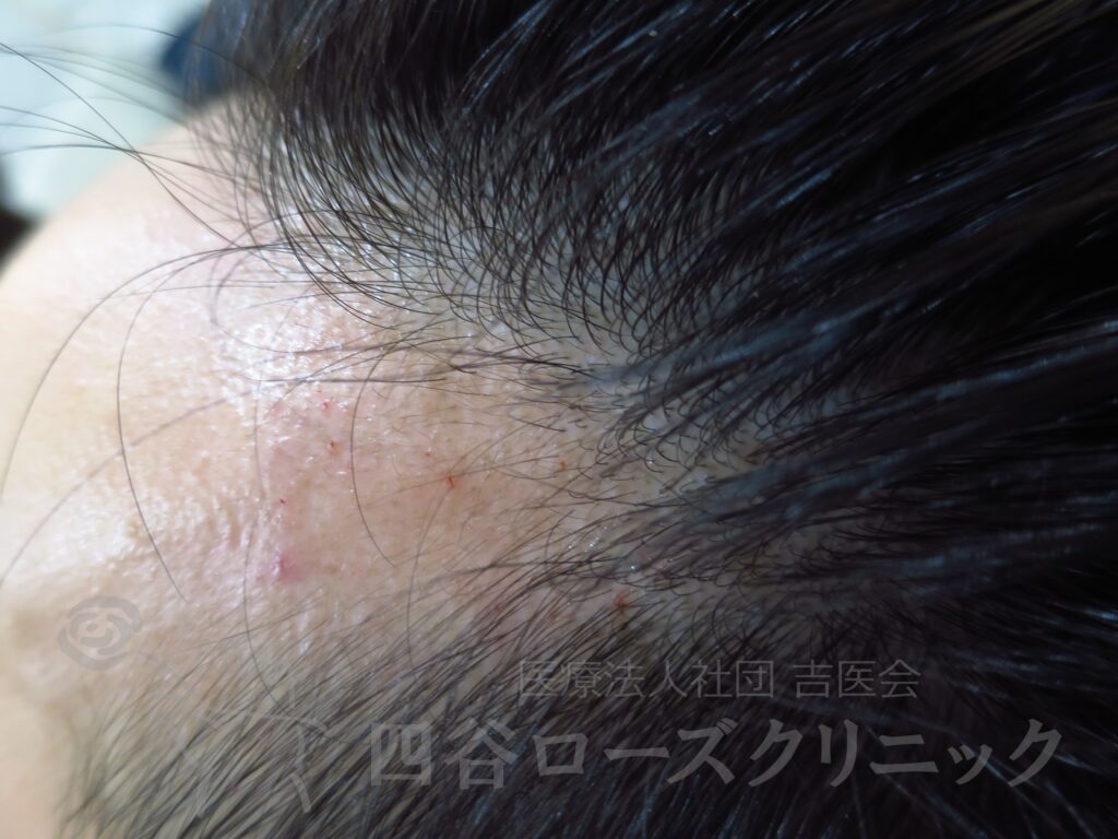 M字の食込み 治療前