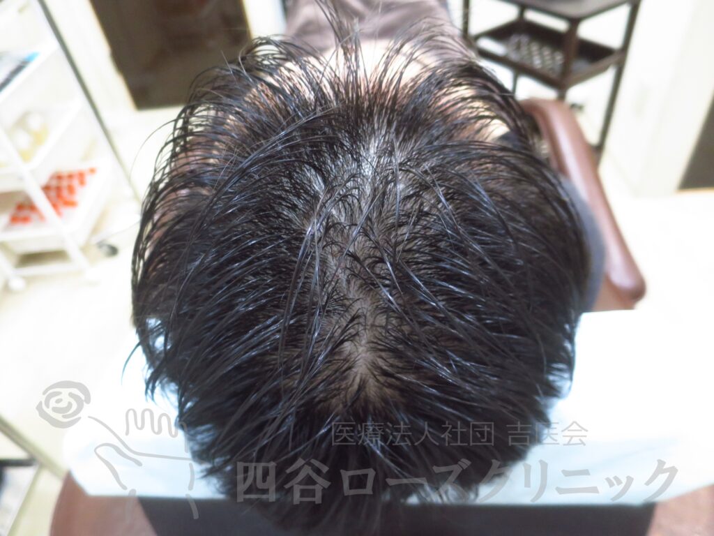 全頭（進行度Ⅱa） 治療前
