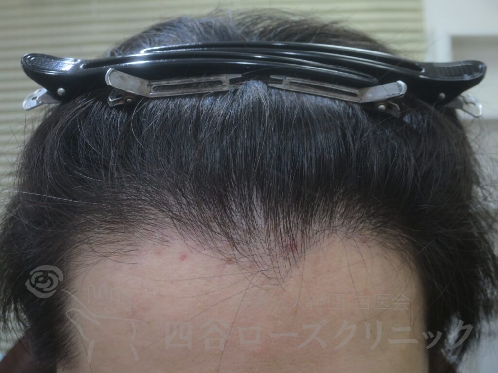 生え際の後退 治療後