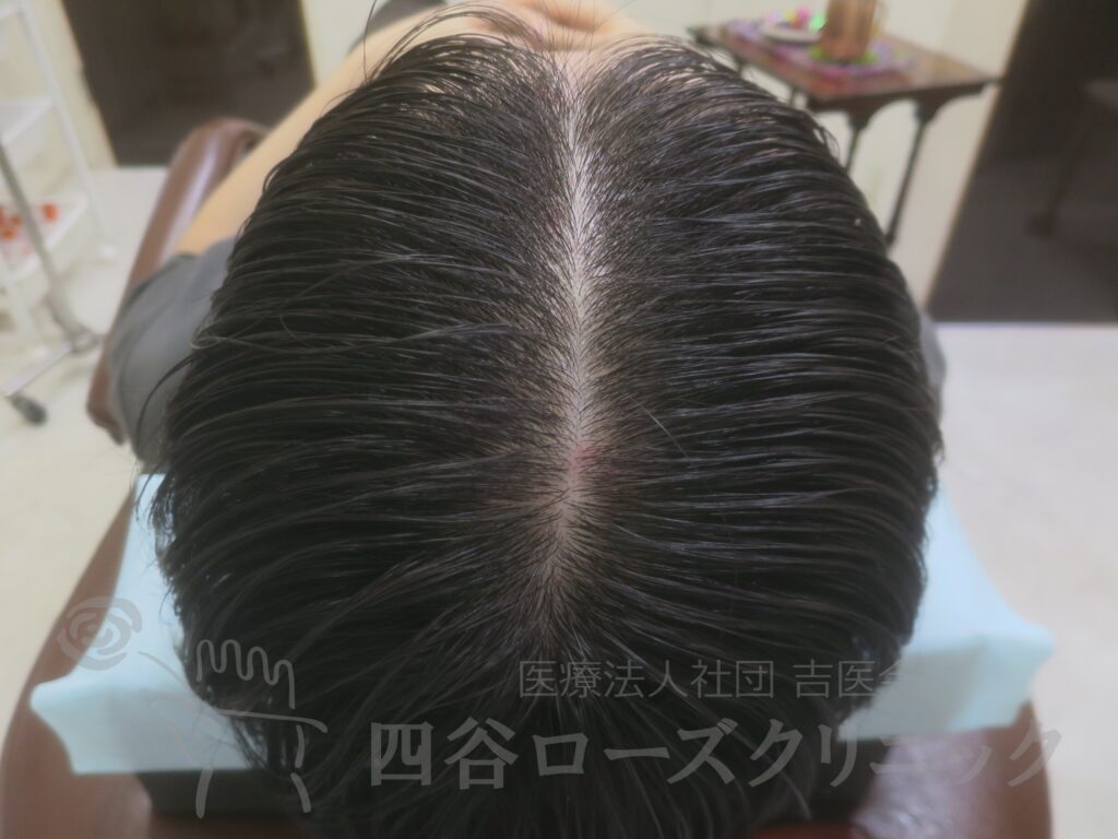前頭部（進行度Ⅱa） 治療後