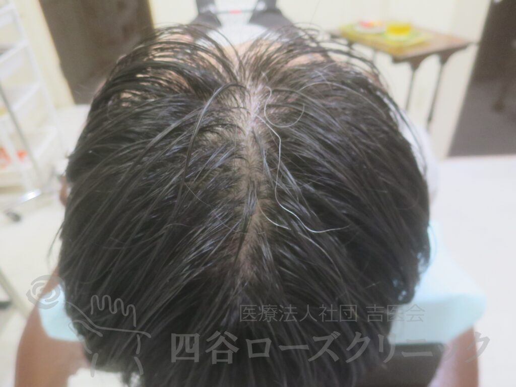 前頭部（進行度Ⅱa） 治療前