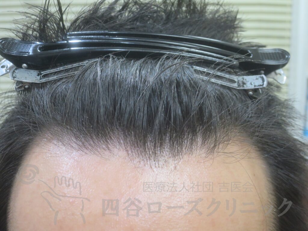 生え際の後退 治療前