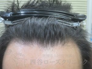 治療前