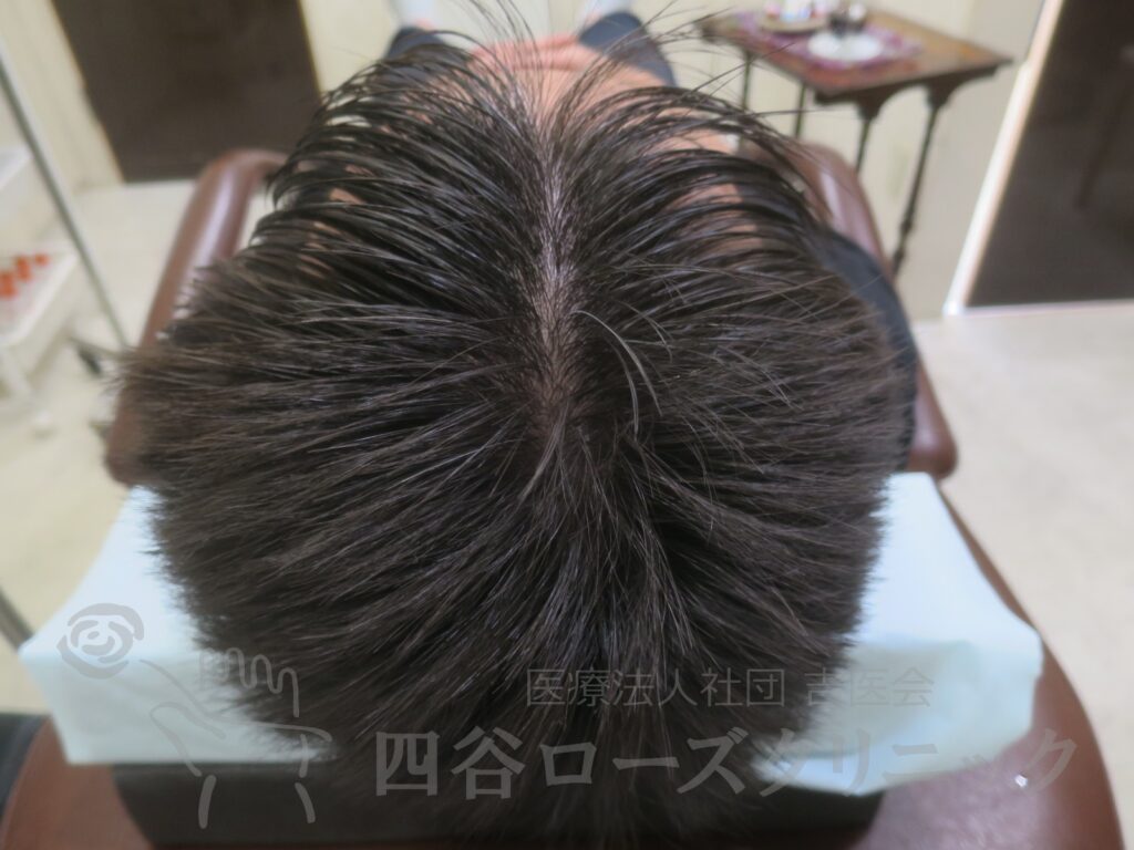 前頭部（進行度Ⅱa） 治療後