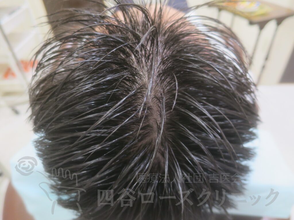 前頭部（進行度Ⅱa） 治療前