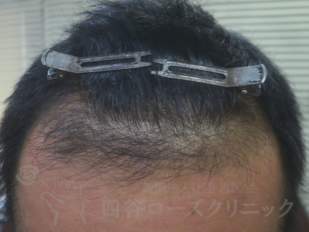 生え際の後退 治療後