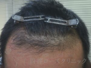 治療後