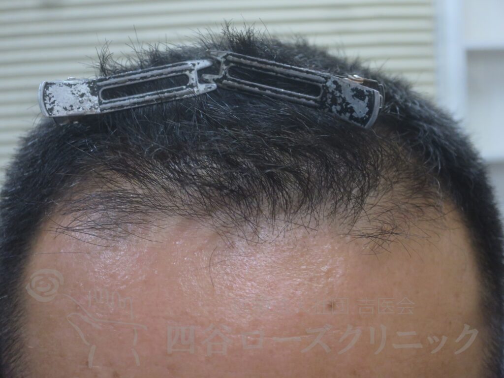 生え際の後退 治療前