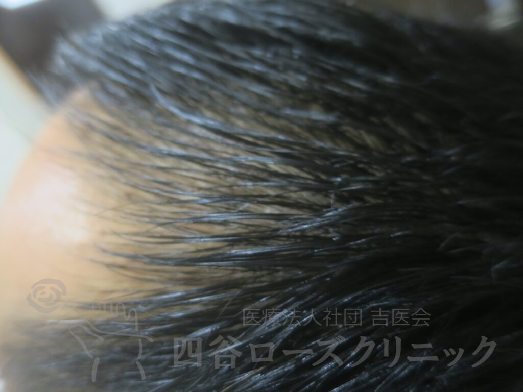 M字の食込み 治療後