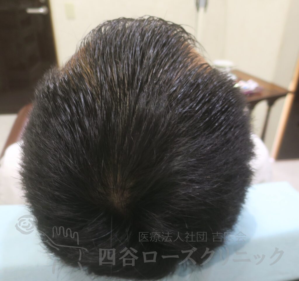 全頭（進行度Ⅲa） 治療後