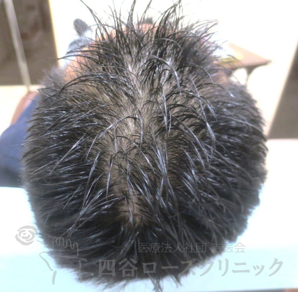 全頭（進行度Ⅲa） 治療前