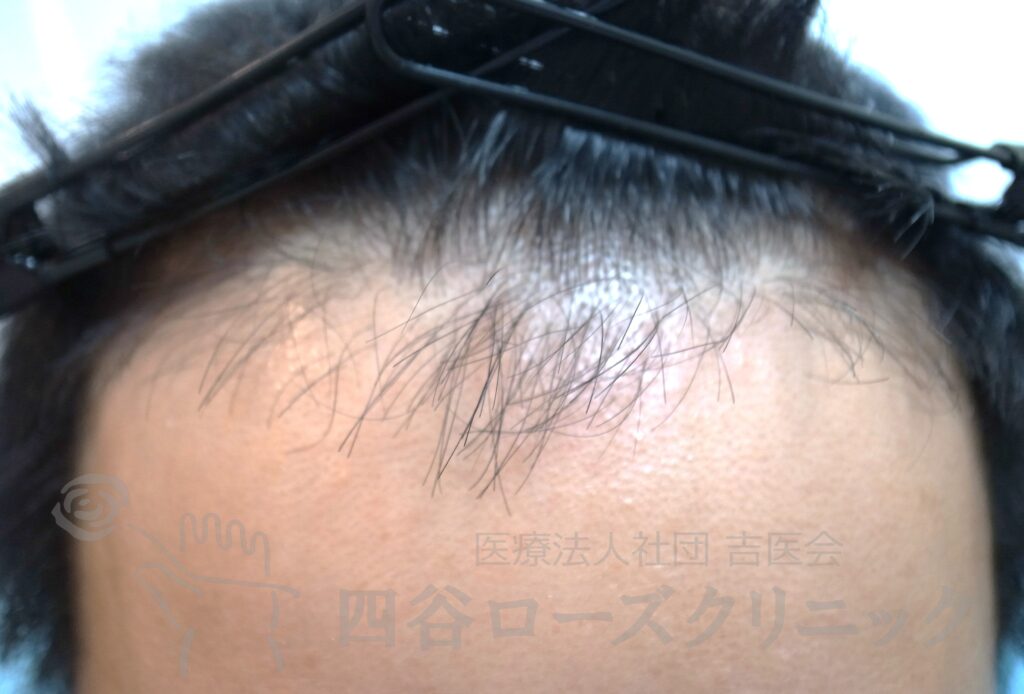 生え際の後退 治療前