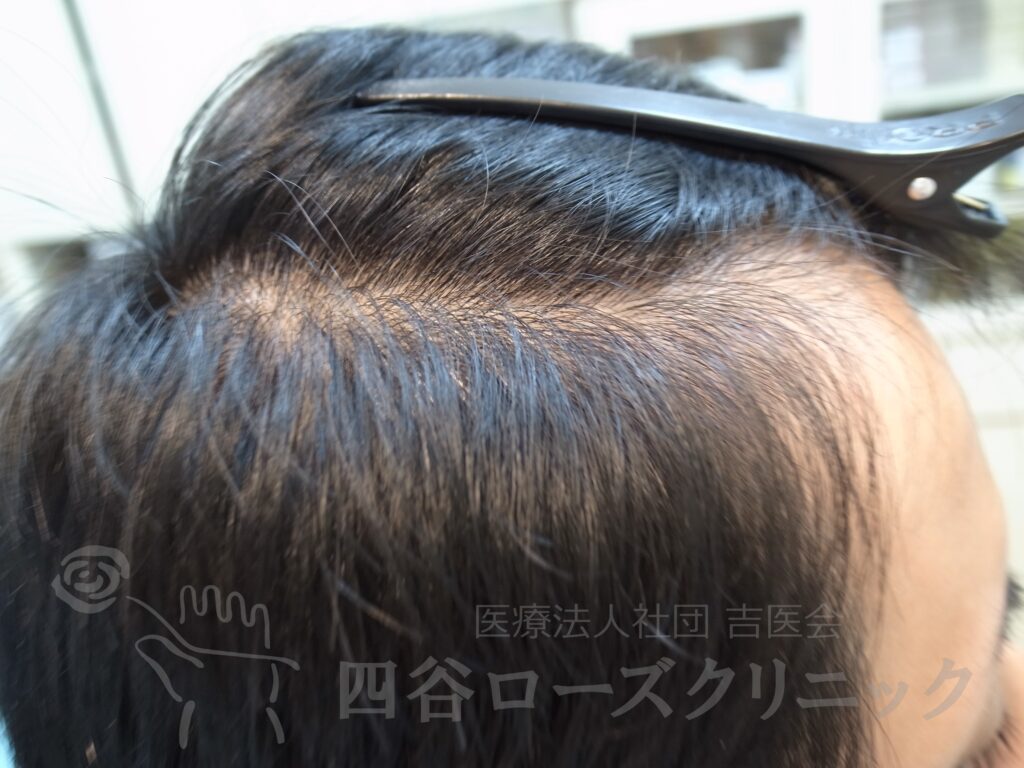 M字の食込み 治療前