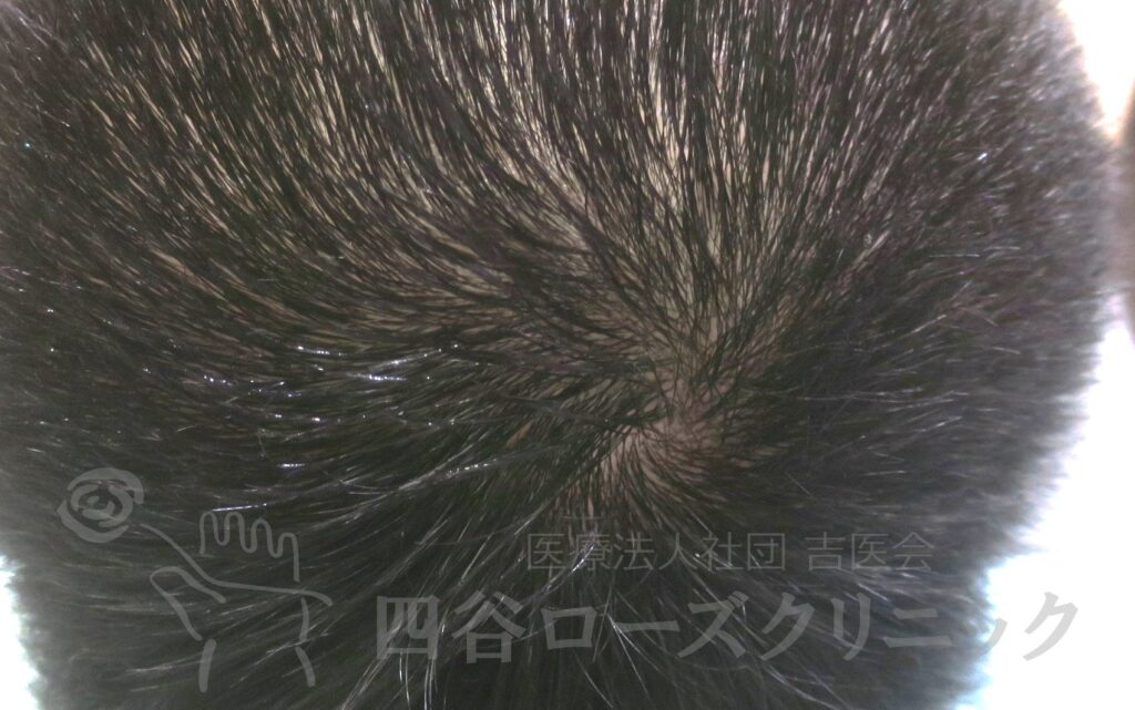 つむじの拡大 治療後