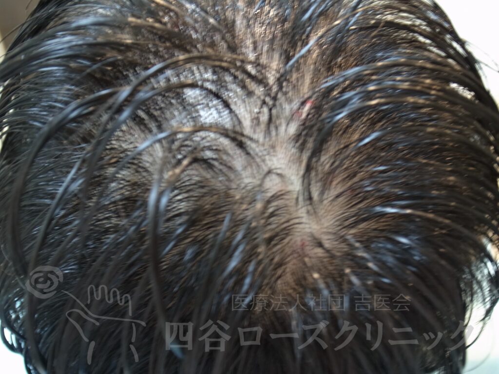 つむじの拡大 治療前