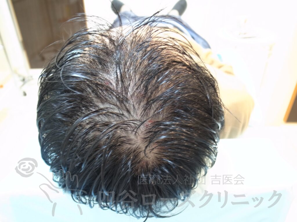 全頭（進行度Ⅲa） 治療前