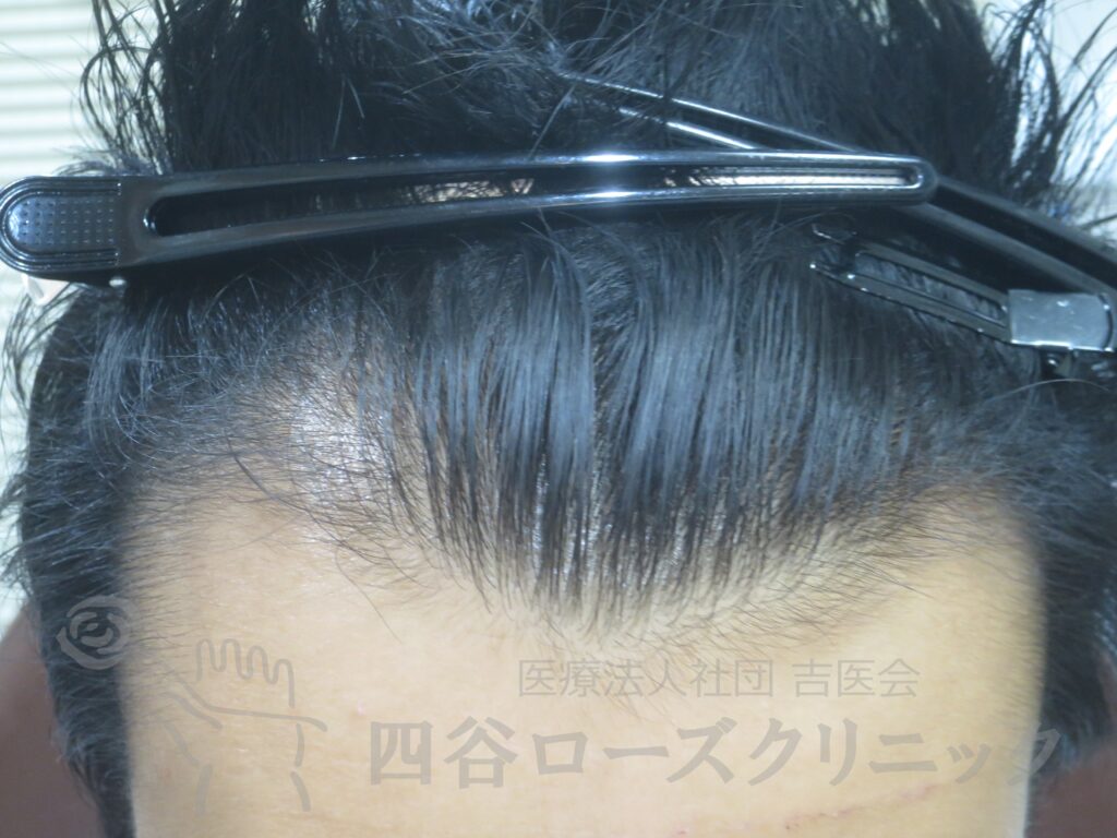 生え際の後退 治療前