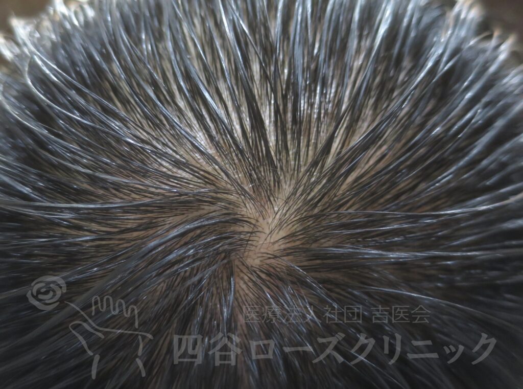 つむじの拡大 治療後