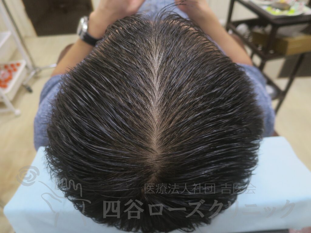 全頭（進行度Ⅲa） 治療後
