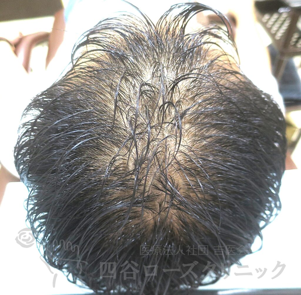 全頭（進行度Ⅲa） 治療前