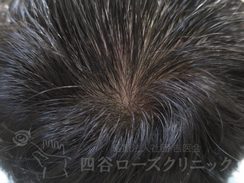 つむじの拡大 治療後