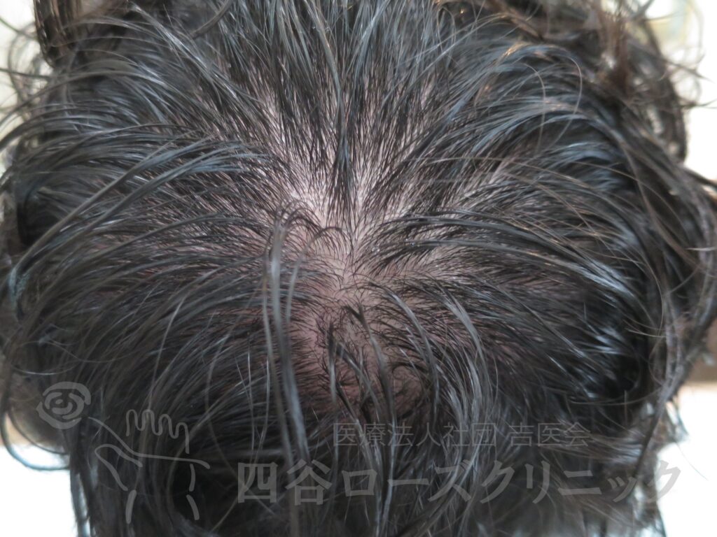 つむじの拡大 治療前