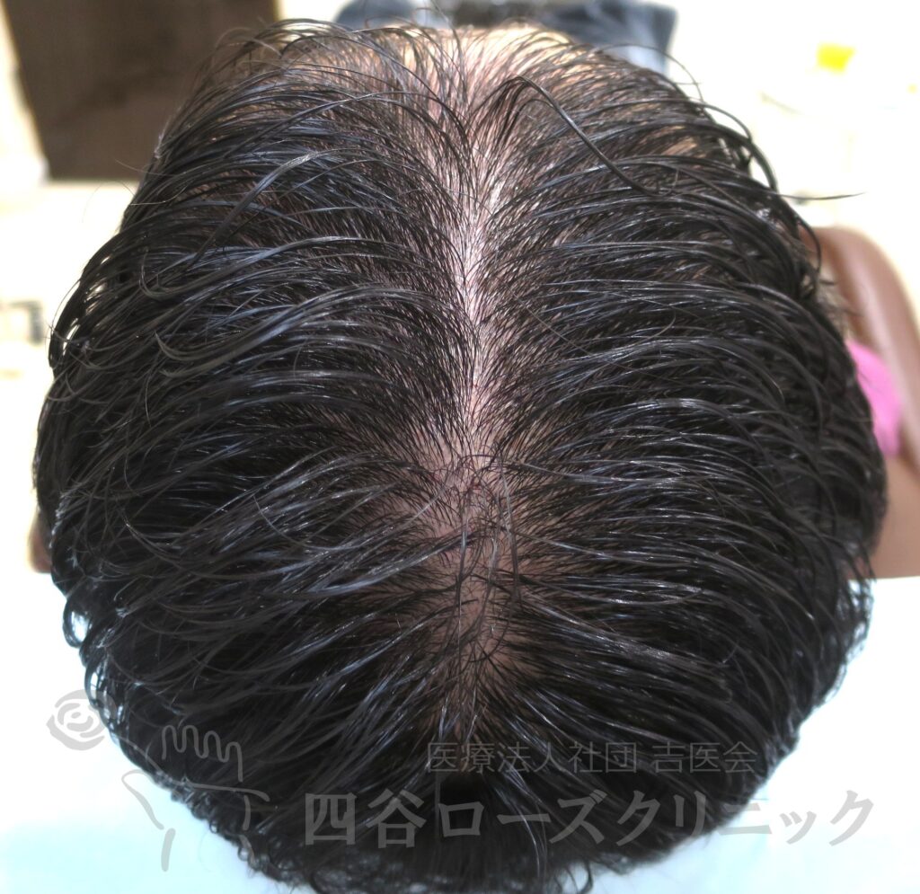 全頭（進行度Ⅲa） 治療後